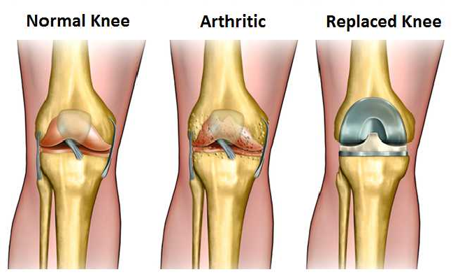 Comprehensive Study Of Total Knee Replacement Surgery