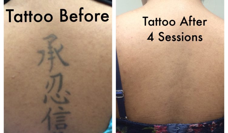 Looking For Tattoo Removal: Know The Cost